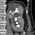 Cystic Nephroma